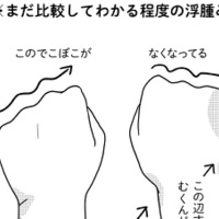 術後9ヵ月に発症した「リンパ浮腫」。有効なケア法を試してみたら、むくみ具合が…【乳癌日記 #50】