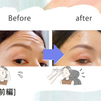 「おでこにシワがなくなるだけでこんなに違うの!?」43歳、5分で若見えするコスパ抜群な美容医療にハマった理由