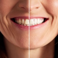 「歯ぐきの老化でオバサン化が加速」。「エストロゲンが減少」する更年期女性ほど歯ぐきケアが大事な理由とは【専門家が解説】