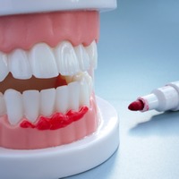 「心筋梗塞や脳梗塞、認知症、糖尿病も!?」隠れた原因は口内環境にあり!?実はこわい「歯の病気」とは【専門家が解説】