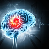 放置すると「脳梗塞リスク」が増加!? 専門家が明かす「たいしたことない」と見逃されがちな「前段階の病気」とは