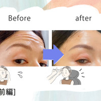 「おでこにシワがなくなるだけでこんなに違うの!?」43歳、5分で若見えするコスパ抜群な美容医療にハマった理由