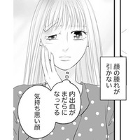 顔だけが取り柄の私なのに腫れが引かない。これからどうすればいいの？【かつて女の子だった人たちへ #32】