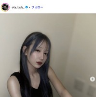 「月曜から夜ふかし」多田さん「腫れがしぶといよ」両顎・輪郭手術から1ヶ月の経過報告「かなり良くなってきてますね」