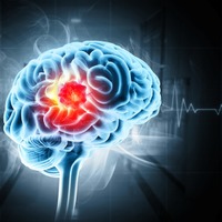 放置すると「脳梗塞リスク」が増加！？ 専門家が明かす「たいしたことない」と見逃されがちな「前段階の病気」とは