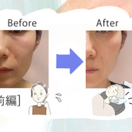 美容課金にハマった44歳が人生初のハイフを体験。「実は一番悩んでいた」たるみはどう変わるのか？気になる痛みは？