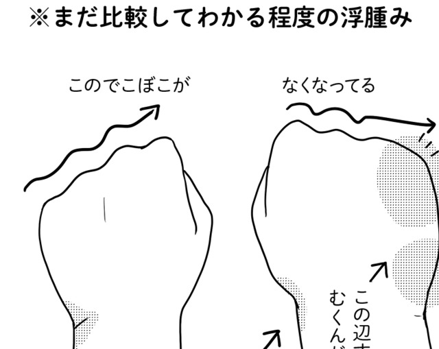 術後9ヵ月に発症した「リンパ浮腫」。有効なケア法を試してみたら、むくみ具合が…【乳癌日記 #50】