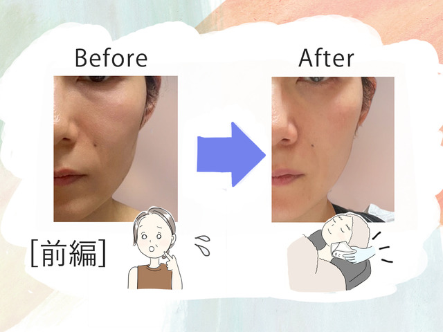 美容課金にハマった44歳が人生初のハイフを体験。「実は一番悩んでいた」たるみはどう変わるのか？気になる痛みは？