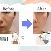 美容課金にハマった44歳が人生初のハイフを体験。「実は一番悩んでいた」たるみはどう変わるのか？気になる痛みは？ 画像